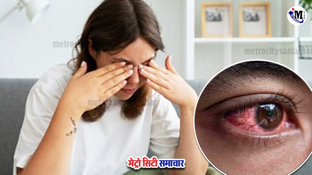 eye infection mumbai rain season
